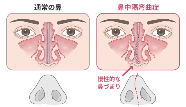 鼻中隔弯曲症の状態を、鼻腔の断面図を用いて通常の鼻と比較しています。鼻中隔が強く曲がることで片方の空気の通り道が狭くなり、慢性的な鼻づまりが起こる仕組みを描いています。