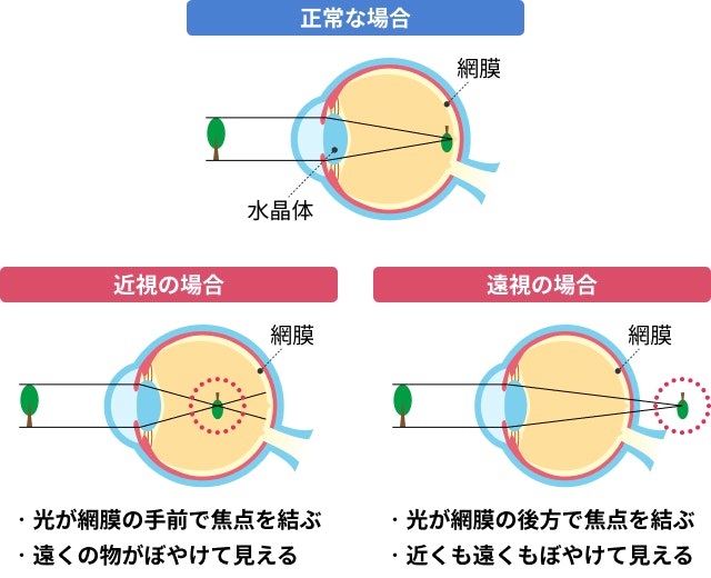 近視と遠視を説明する図です