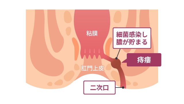 痔瘻を説明する図です
