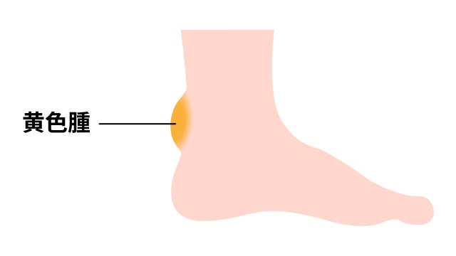 アキレス腱などの黄色腫を説明する図です