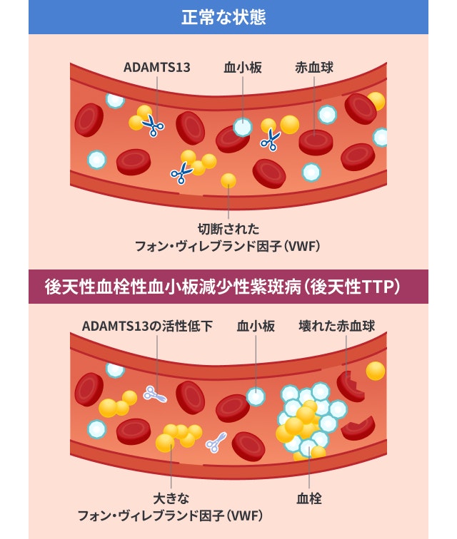 後天性血栓性血小板減少性紫斑病を説明する図です