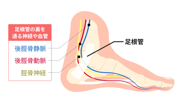 足根管症候群」とはどのような病気ですか？ ｜足根管症候群