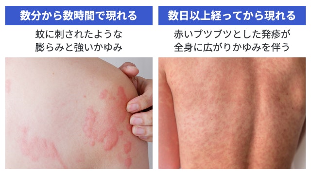 ペニシリンアレルギーによる発疹の特徴として2つの症例写真。左：薬を飲み始めて数分から数時間で現れる即時型は、蚊に刺されたような膨らみ（膨疹）と強いかゆみを伴う。右：薬を飲み始めて数日以上経ってから現れる遅延型は、赤いブツブツとした発疹が全身に広がり、かゆみを伴う。