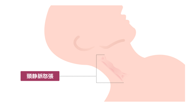 頸静脈怒張 頚静脈怒張の見た目はどのようになりますか？ ｜頚静脈怒張（首