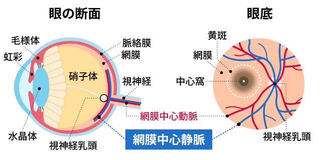 網膜静脈閉塞症を説明する図です