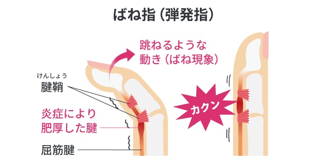 ばね指のメカニズムを示す断面図。炎症によって肥厚した屈筋腱が腱鞘に引っ掛かり、指を伸ばす際に「カクン」と跳ねるようなばね現象が起きる仕組みを分かりやすく解説しています。