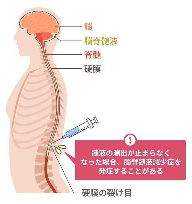 CSF（脳脊髄液）の検査を説明する図です