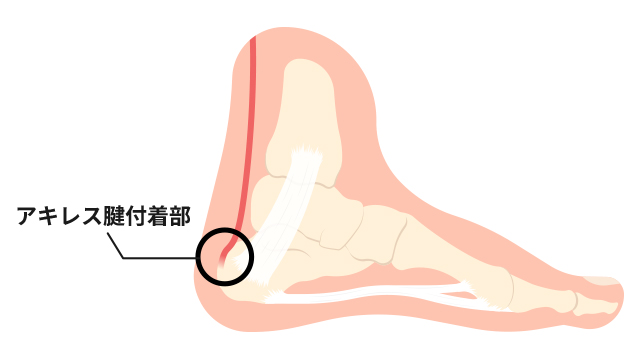 靴のかかとがチクチクする