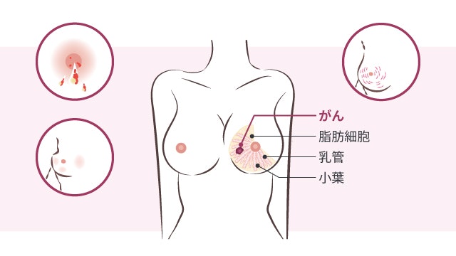 局所進行乳がんを説明する図です