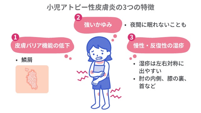 小児アトピー性皮膚炎の3つの特徴を説明する図です