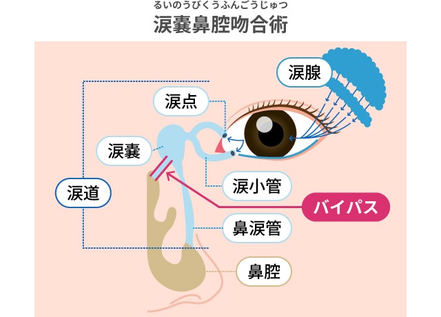 涙道閉塞の手術を説明する図です
