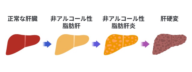 非アルコール性脂肪肝の状態について説明する図です