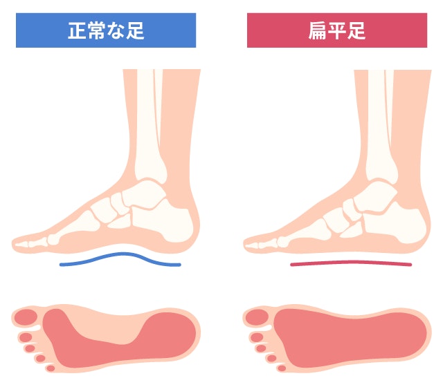 正常な足と扁平足の、骨格の状態と足跡を、左右に並べて比較したイラストです。扁平足では土踏まずが潰れて、足裏全体が地面に接地しています。