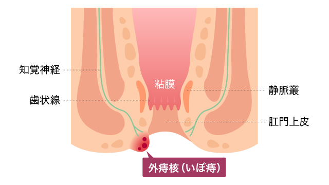 外痔核ができる位置を説明する図です