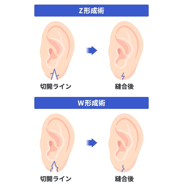 Z形成術・W形成術を説明する図です