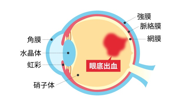 眼底出血を説明する図です