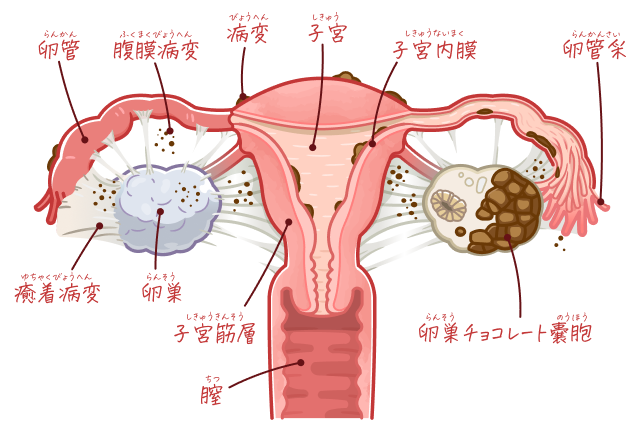 子宮内膜症が発生する場所についての図です