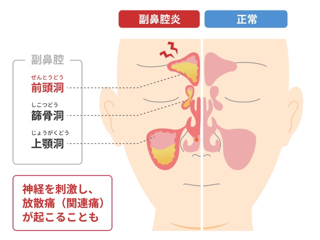 前頭洞の炎症を説明する図です