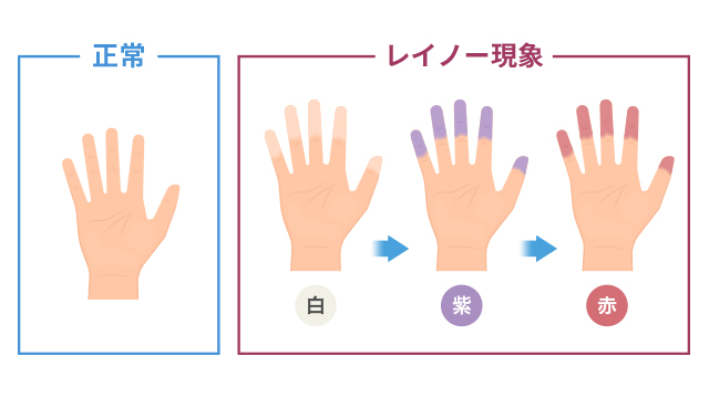 強皮症」とあなたの症状との関連性をAIで無料チェック