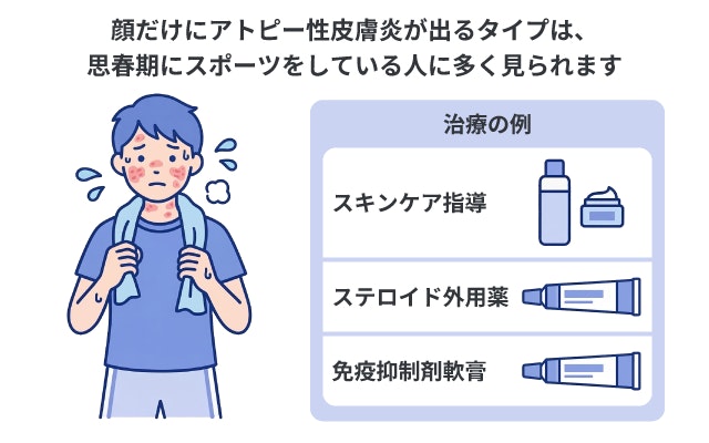 アトピー性皮膚炎が顔面のみに出るタイプの特徴と治療例の解説図。思春期にスポーツをしている人に多いことを表すイラストと、スキンケア指導、ステロイド外用薬、免疫抑制剤軟膏といった治療法を紹介しています。