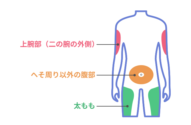 自己注射部位を説明する図です