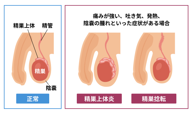 精巣の痛み（睾丸痛）」とはどのような症状ですか？ ｜精巣の痛み（睾丸痛）