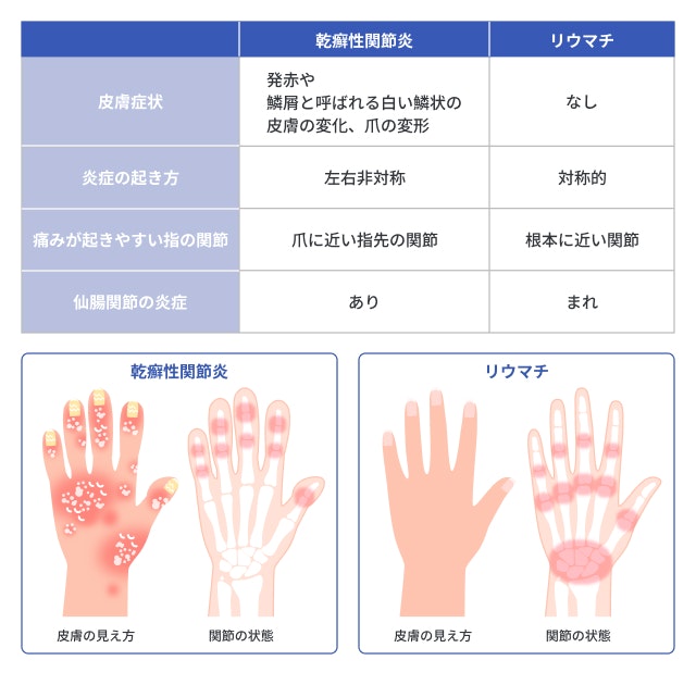 乾癬性関節炎とリウマチの違いを説明する図です