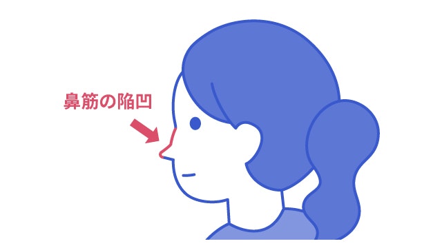 鞍鼻による鼻の形ついて説明する図です