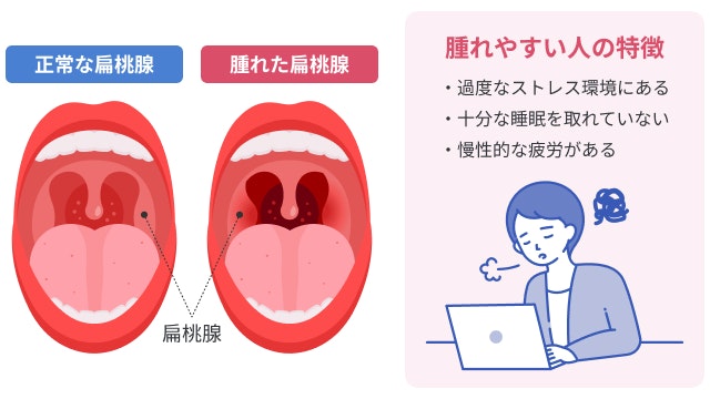 扁桃腺が腫れやすい人の特徴を説明する図です