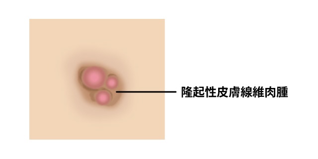 隆起性皮膚線維肉腫を説明する図です