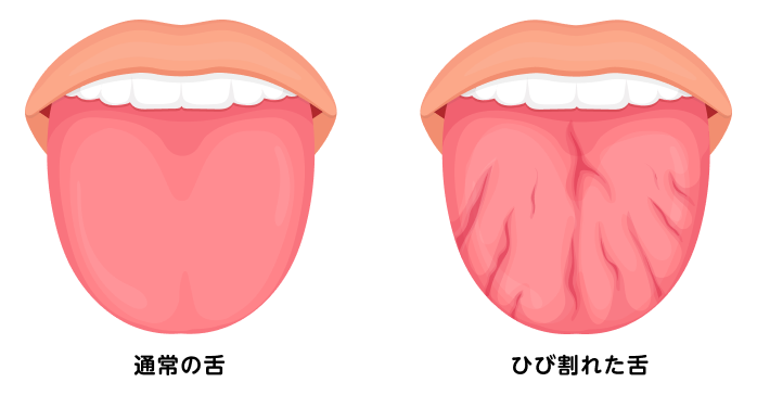 通常の舌とひび割れた舌を説明する図です