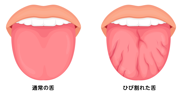 シェーグレン症候群の人の舌の写真には、どのような特徴が見られますか？ ｜シェーグレン症候群