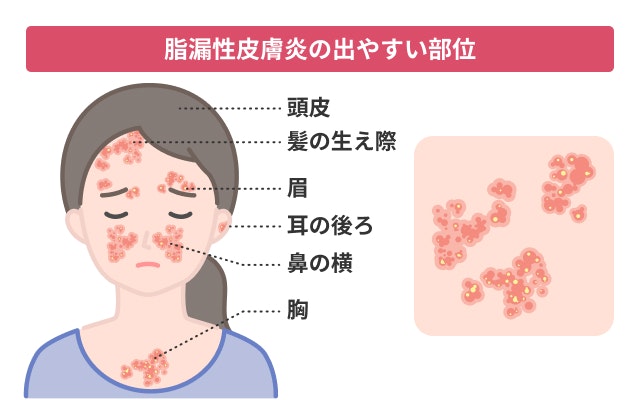 脂漏性皮膚炎では、頭皮、髪の生え際、耳の後ろ、眉、鼻の横、胸などといった皮脂の分泌が盛んな部位に、乾燥した、または脂ぎったうろこ状のかさつきであるフケを生じ、赤みやかゆみが見られることもあります。