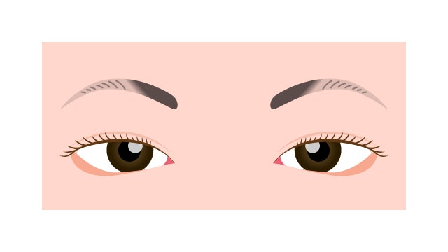 歌舞伎症候群を説明する図です