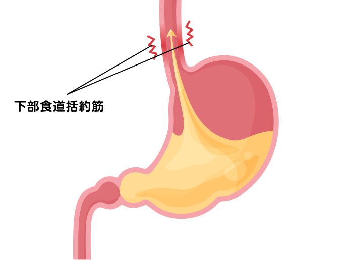 下部食道括約筋が緩み胃液が逆流しているのを説明する図です