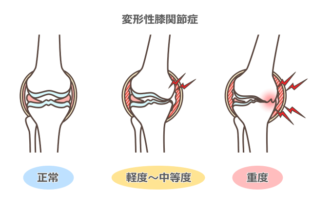 変形性膝関節症について説明した図です。