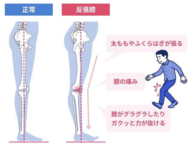 反張膝の症状について説明する図です