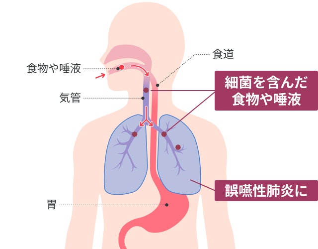 誤嚥を説明する図です