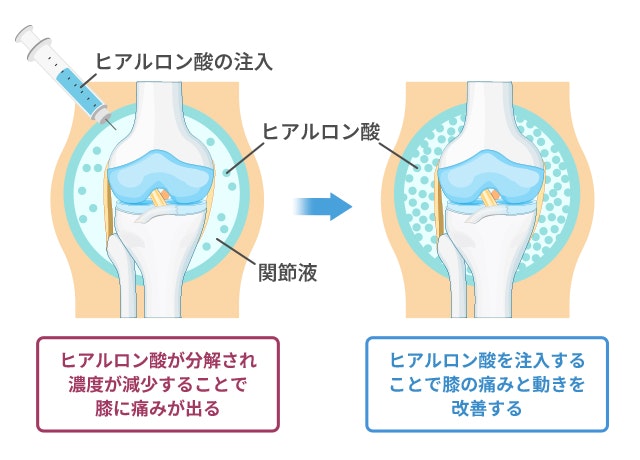 膝にヒアルロン酸を注入するイラスト