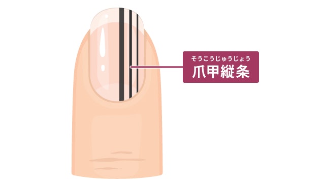 アジソン病による爪の変化を説明する図です