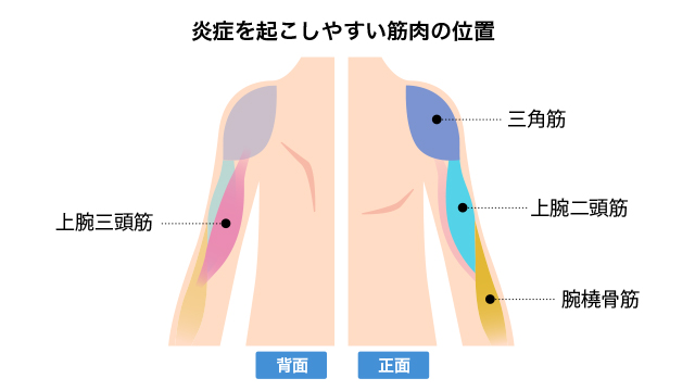 腕の筋が痛い場合、何が原因として考えられますか？対処法はありますか？ ｜腕が痛い