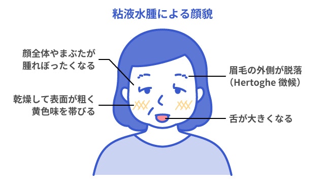 粘液水腫による顔貌の変化を説明する図です
