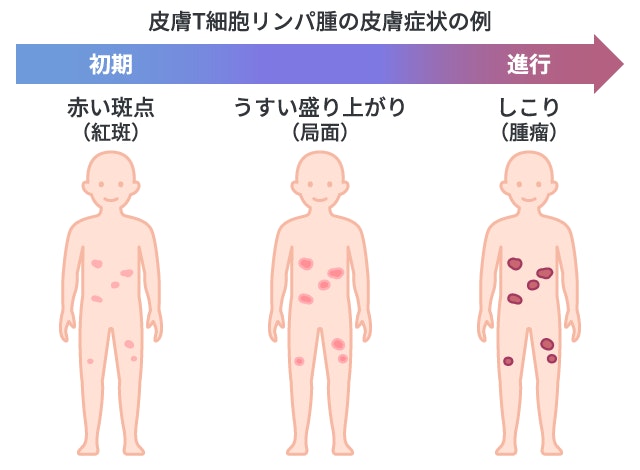 皮膚T細胞リンパ腫の皮膚症状の例を示した人物のイラスト。左から右へ経過を示しており、初期は赤い斑点（紅斑）、うすい盛り上がり（局面）、進行するとしこり（腫瘤）ができている。