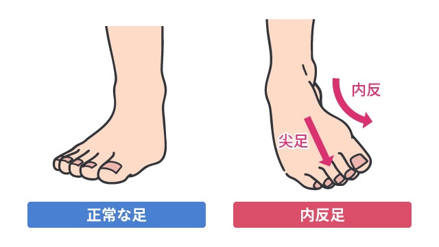 内反足の特徴を説明する図です
