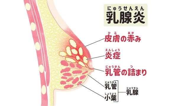 乳腺炎を説明する図です