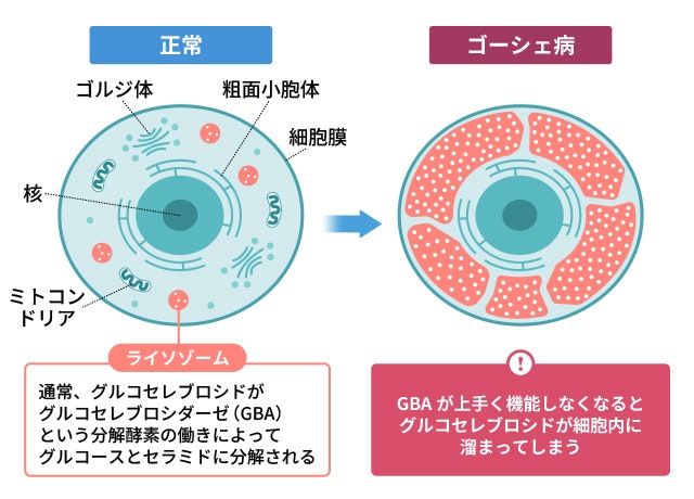 ゴーシェ病・ゴーシェ細胞のイラスト