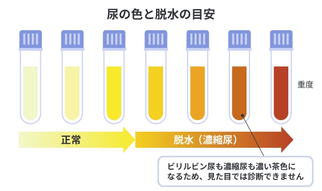 尿の色から脱水の程度を確認できるチャート。正常な薄い黄色から脱水による濃い茶色の濃縮尿までを7色で比較し、ビリルビン尿と濃縮尿はどちらも濃い茶色であるため、見た目だけで診断できないことを説明しています。