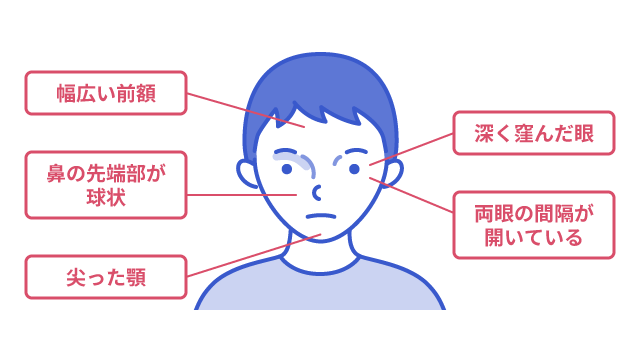 アラジール症候群における顔つきの特徴を説明する図です