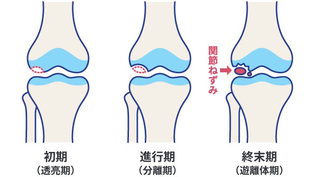 離断性骨軟骨炎を説明する図です