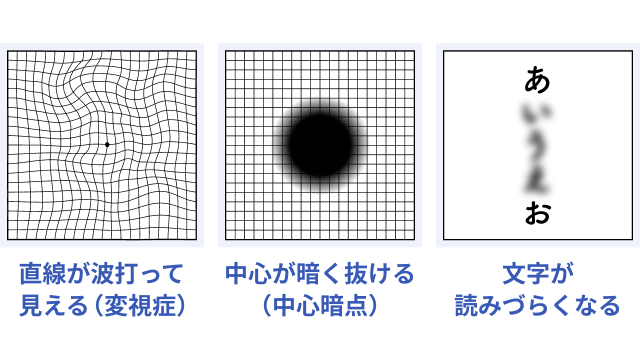 加齢黄斑変性になると、見え方はどうなりますか？画像やイラストで教え